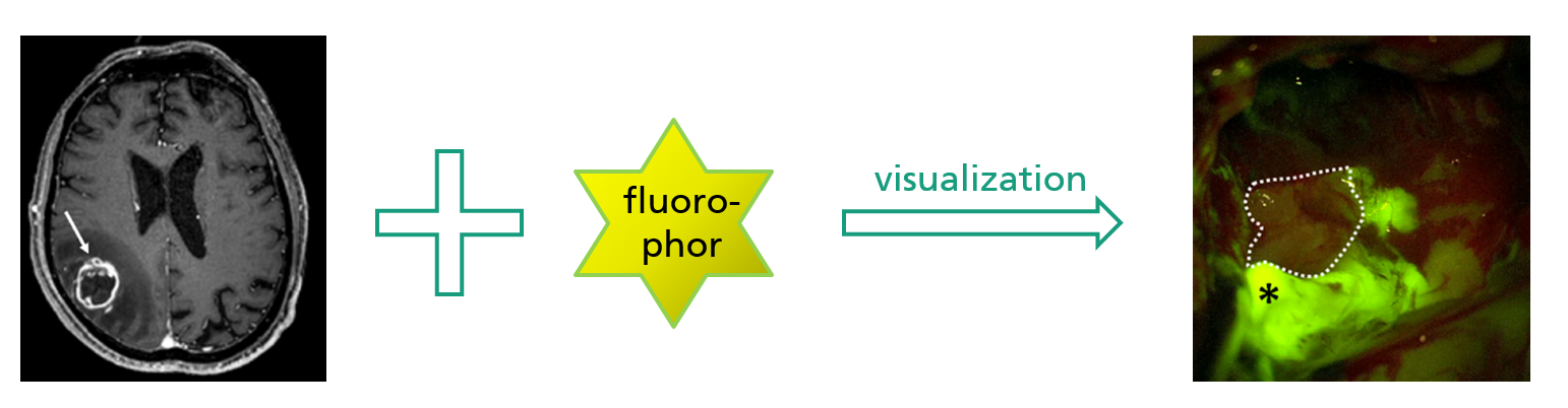 Visualization of specific staining of tumor tissue by use of fluorophor